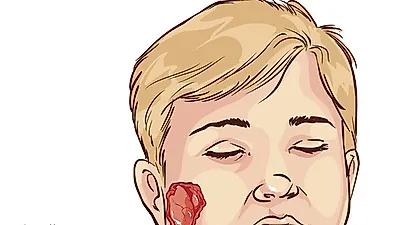 커진 우리 아이 볼! '볼거리'가 뭐길래?…심하면 뇌수막염 일으켜