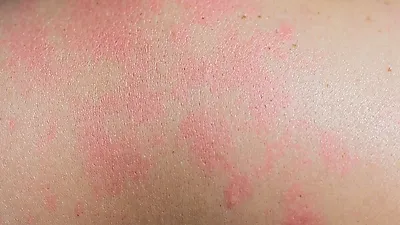 여름철 다가오는데 '햇빛 알레르기' 걱정…햇빛알레르기 원인과 치료법은?