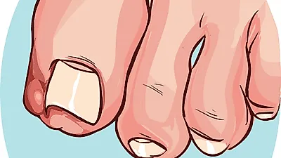울퉁불퉁 손톱 검은 세로줄, 흑색종 증상이다? 교정기·테이프로 내성발톱 자가치료 및 병원 자르기 수술