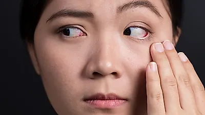 눈가 비립종 내버려두면 번질까? 비립종 원인 및 '비립종제거' 방법