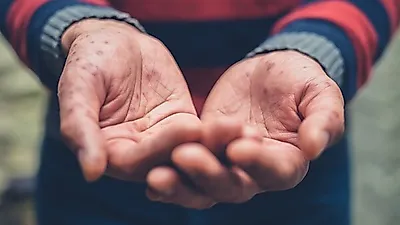 [육아상식]   "손과 발에 피부 발진 보여"수족구병, 생활 속 예방수칙 알아보자