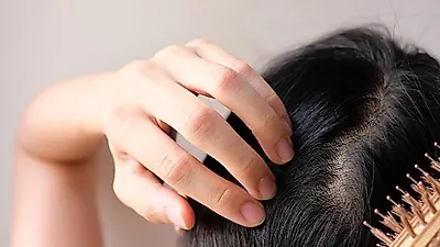 두피 여드름 원인은? 지루성 피부염 방치하면 '탈모' 생길 수 있어 주의해야…