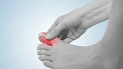 엄지발가락 통증이 '통풍' 초기증상?..통풍에 좋은 음식 vs 통풍에 안좋은 음식 BEST 5