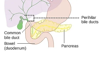 갑자기 황달이 오면 담도암 증상 가능성...담도암 말기되면 수술 불가