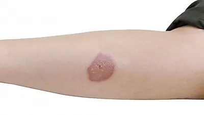 화상 병원 가기 전! 화상 흉터 줄이는 화상 응급 처치 방법