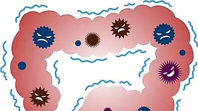 겨울철 '유행성 장염', 노로바이러스 감염증 알고 가기