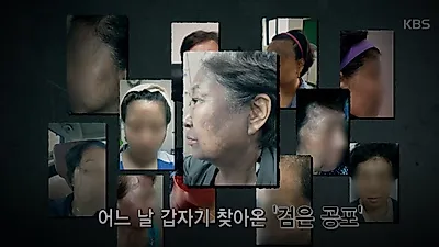 심각한 상처 남긴 '헤나염색 부작용', 공포의 검은 색소로 고통 받는 피해자들