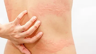 급성 만성 두드러기? 두드러기원인과 종류 정리