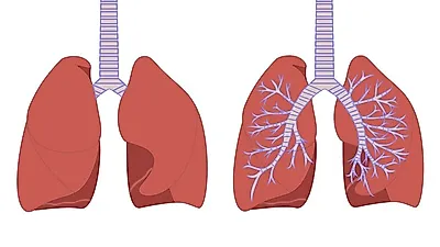 '감기로 오인' 사망까지 이어지는 폐렴 초기 증상, 백신 접종으로 100% 예방 가능할까? 