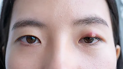 눈 다래끼 원인 '포도상구균' 전염되지는 않아, 초기증상 빨리낫는법은 '렌즈·아이라인' 삼가야