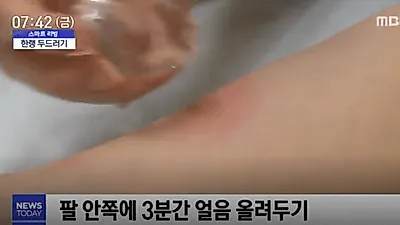 '한랭 두드러기' 증상이 심하면 쇼크사 불러올 수 있어…원인과 치료법 및 예방법 알아보자