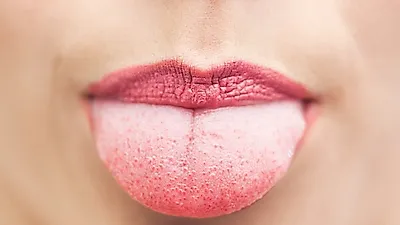 [혀로 보는 건강] 혀 갈라짐·혓바닥 색깔 등 혀 건강상태! 혀 백태 원인·제거 혀클리너 사용법
