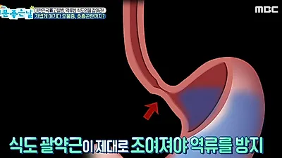 역류성식도염 완화하는 베개 높이? 기침·가슴통증 유발해 위내시경 필요