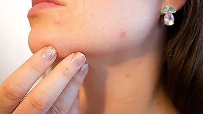 '턱여드름' 원인, 자궁질환과 연관?...남자턱여드름원인 및 진정법
