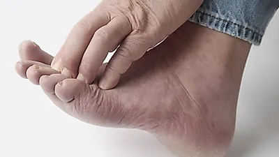 무좀 초기증상 있다면…신속한 무좀 치료법 필요