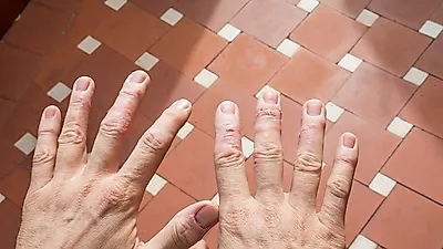 겨울철 자주 발생하는 습진을 알아보자