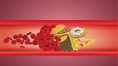 성인 6명 중 1명이 앓고 있는 '고지혈증', 협심증으로 이어질 수 있다?…혈액 검사로 주기적인 검진 필요