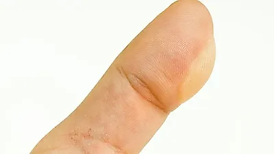 한포진의 원인과 증상, 예방방법을 알아보자
