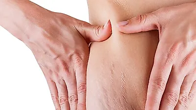 옆구리에 그어진 불쾌한 선 '튼살', 제거할 수 있을까?…수분 충분히 공급해야