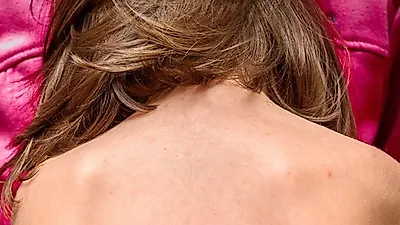 심한두통과 숨쉬기도 힘들 수 있는 대상포진