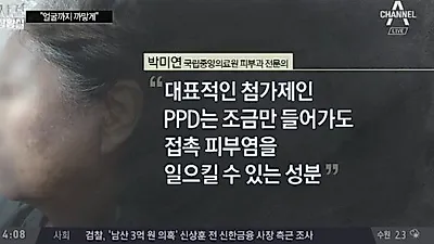 헤나염색 부작용, 대다수 다단계 업체로 유통돼 책임 묻는 일도 어려워…"죽고 싶을 만큼 괴롭다"