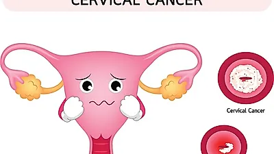 [환절기 건강 관리] 난소암 초기증상과 난소암 전이, 난소암 고위험군 알고 난소암 자가진단하기  