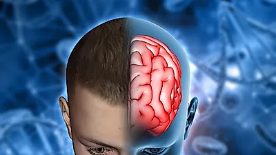 뇌졸중 초기증상…뇌졸중 치료 늦으면 '위험'