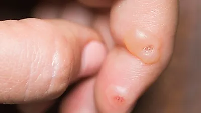 사마귀, 원인과 증상은?…'치료·제거 방법 과 사마귀 약'
