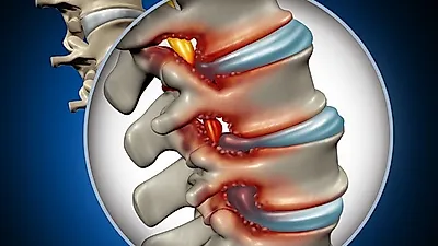 일상생활에 지장을 주는 허리디스크 통증, 요통은 물론 엉치까지 광범위하게 발생해...이에 맞는 치료법은?