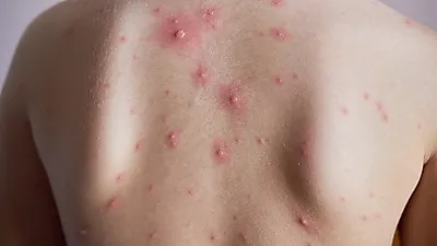 소아기에 흔하게 발생하는 수두의 증상과 치료방법을 알아보자