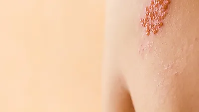 갱년기 여성 위협하는 '대상포진 초기증상 및 전염성'은?..'면역력 높이는 음식'으로 관리!