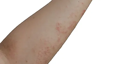 모공 각화증, 피부에 발생하여 미관상 문제를 발생시켜…'닭살피부'