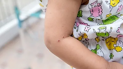 아이 몸에 생긴 물집 '수족구병', 초기증상은?…"발열 및 수포성 발진 생겨"