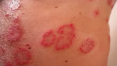 통증을 동반하는 대상포진
