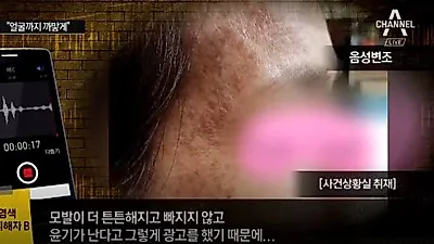 40대‧50대 중장년 여성 주로 피해 '충격' 헤나염색 부작용, 천연 원료라 믿었더니 얼굴 전체가