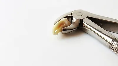 매복사랑니 발치,  한 하면 어떻게 될까?…유의해야 할 점까지   "감염 조심"