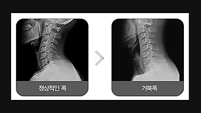 스마트폰 유저들은 거북이? 거북목증후군 방치하면 목디스크까지!