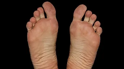 지긋지긋한 발 무좀, 원인과 치료방법