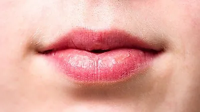 반복적으로 생기는 입술 헤르페스 증상…원인이 무엇일까?