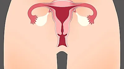 월경통, 골반통 등 자궁근종 증상 고통, 자궁근종이란 무엇?