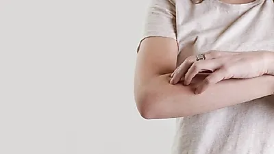 콜린성 두드러기 치료와 원인...생명에 위협 없지만 불편해