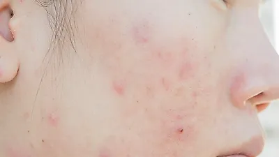 지긋지긋한 성인 여드름 흉터 없애는 법 '등'은 어떻게?