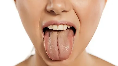 갈라지는 혓바닥…건강이상이 오면 혀에도 나타난다?  혀갈라짐 원인 및 치료법