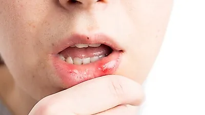 [구내염 빨리 낫는 법] '면역관리가 중요' 구내염의 원인은? 증상·혀 염증·건강상태 진단하기