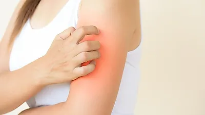 [건강꿀TIP]   "감기 증상과 헷갈릴 수 있어" 대상포진, 심하면 죽음에 이를 수도
