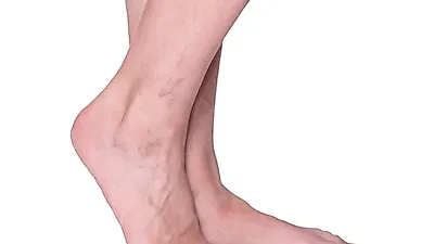 종아리·허벅지 혈관이 울퉁불퉁 올라왔다면? '하지정맥류' 증상 의심 해야