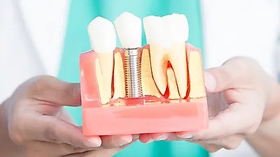 가격차이 있는 틀니·임플란트   다른 점이 무엇이길래?   장점과 단점까지 알아보자
