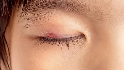 눈꺼풀이 부어오르는 눈 다래끼 초기증상...그냥 놔두면 가라앉아