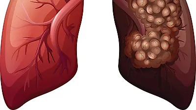 [라돈침대] 라돈 기준치, 라돈측정기 이용방법, 라돈측정기 무료 대여해주는 지역 어디? 
