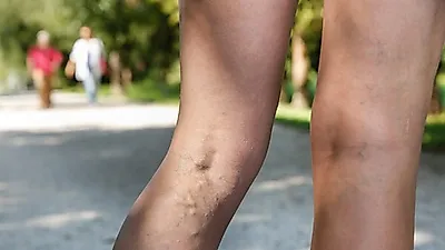 힘줄인가 핏줄인가? 다리 저림, 발 저림 '하지정맥류' 초기증상, 병원 방문 전 종아리 마사지와 의료용 '압박스타킹'으로 호전 기대할 수 있을까?